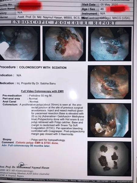 কলোনস্কপির মাধ্যমে EMR অপারেশন ২