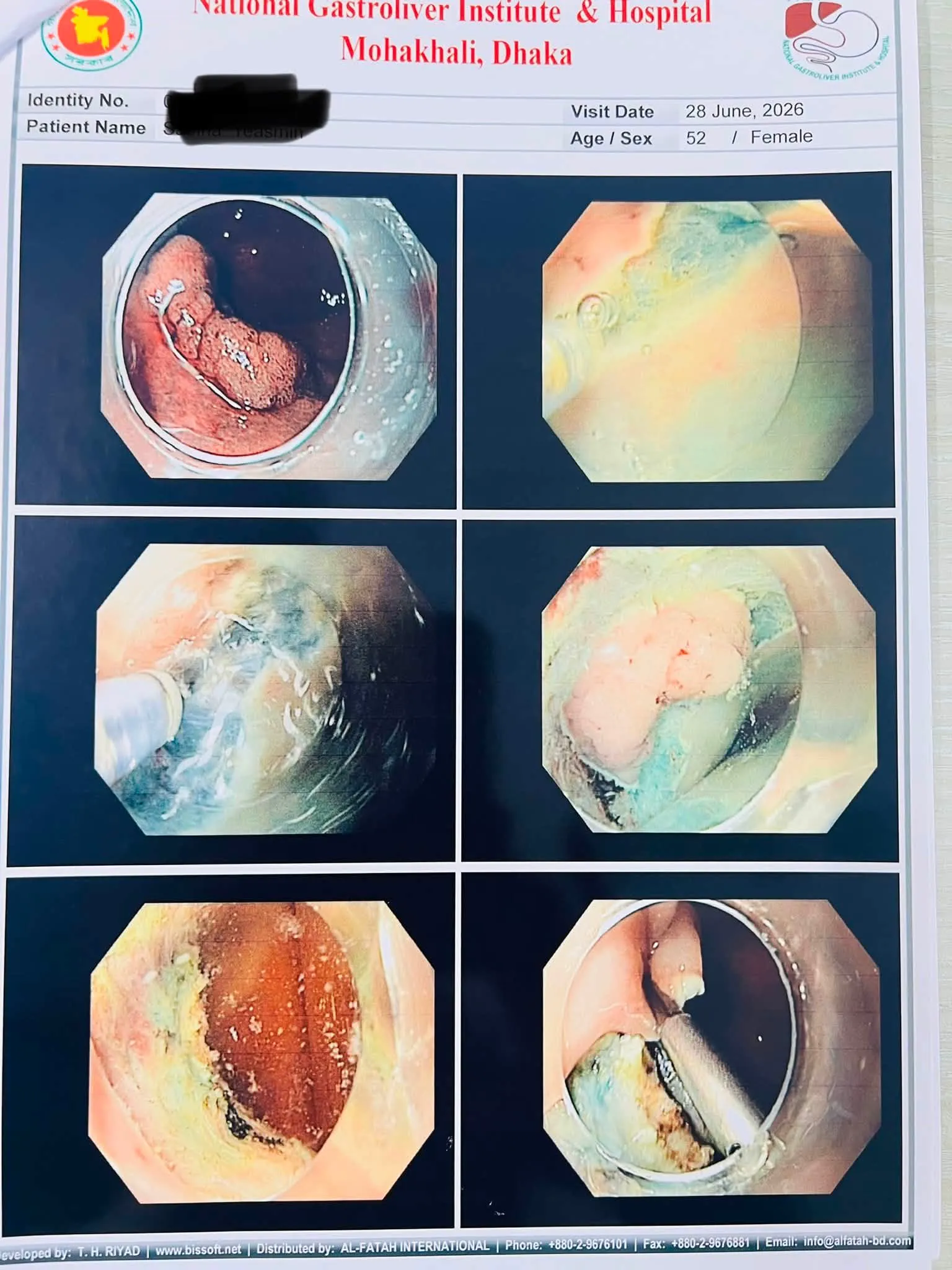 ESD চলাকালীন এন্ডোস্কোপিক ভিউ